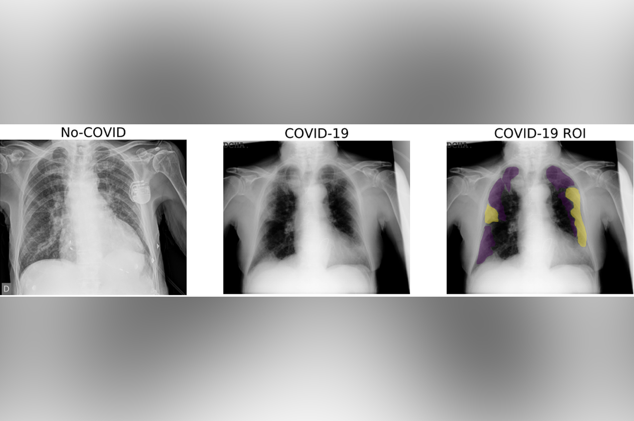 Detección de COVID a partir de imágenes de Rayos X, de Tórax