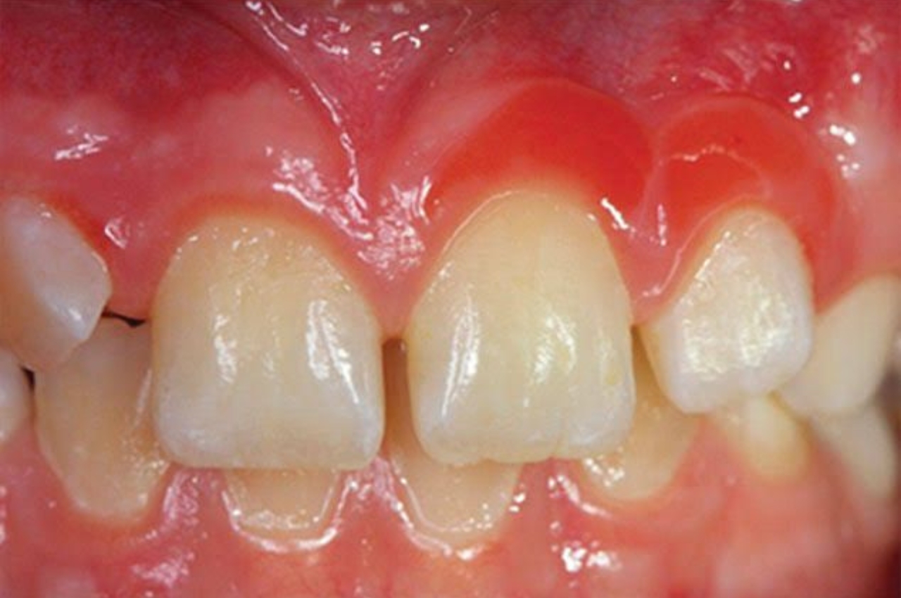 Hiperplasia espongiótica