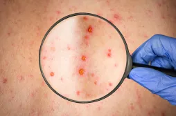 Varicela: Cómo identificar los síntomas y evitar el contagio